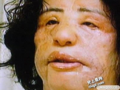 整容失败率有多高 世界10大最可怕的整形失败案
