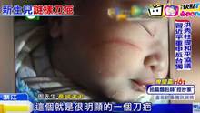 陆婴剖腹后脸上遭划伤 医：孕妇肚皮太薄